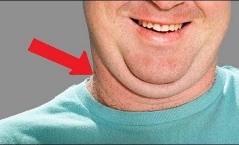 Αίτια ροχαλητού - λίπος στο λαιμό fatneck