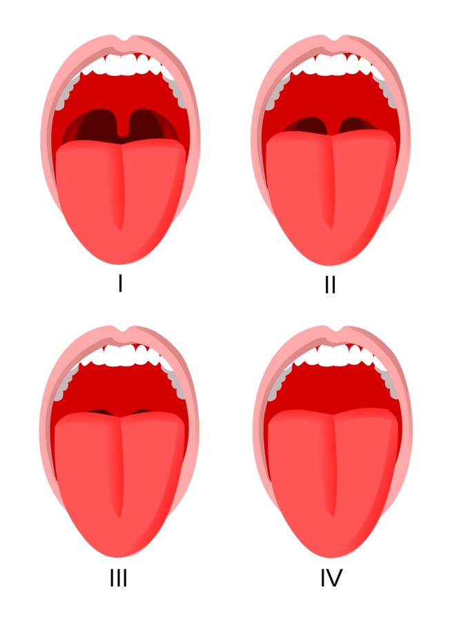 Αιτίες ροχαλητού - Μεγάλο μέγεθος γλώσσας glwssa