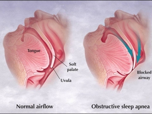 Obstructive sleep apnea